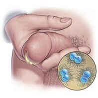secrezione di gonorrea